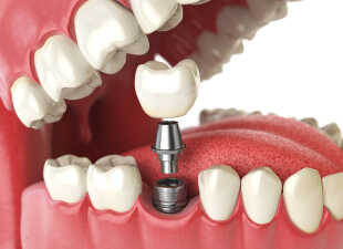 single implant