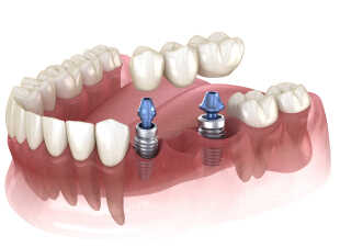 multiple implant