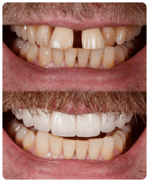 before after