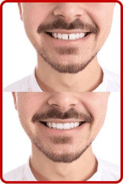 before after